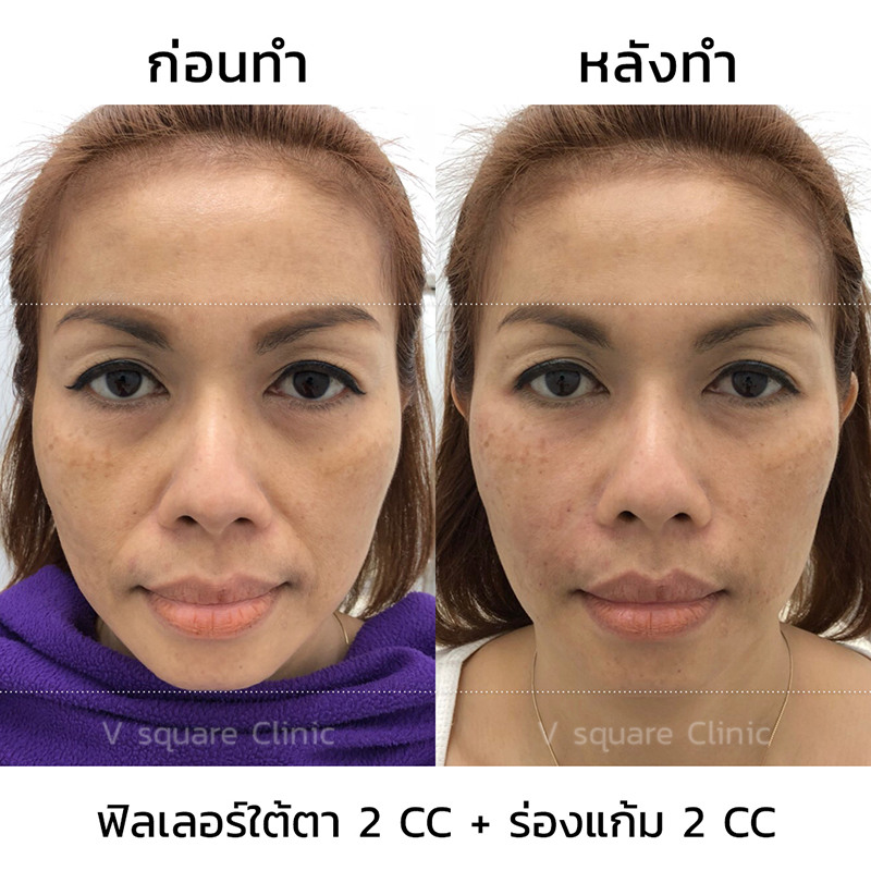 รีวิวฟิลเลอร์ยกหน้า5