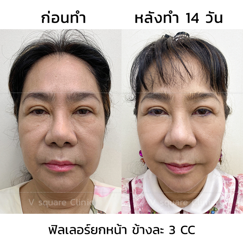 รีวิวฟิลเลอร์ยกหน้า8