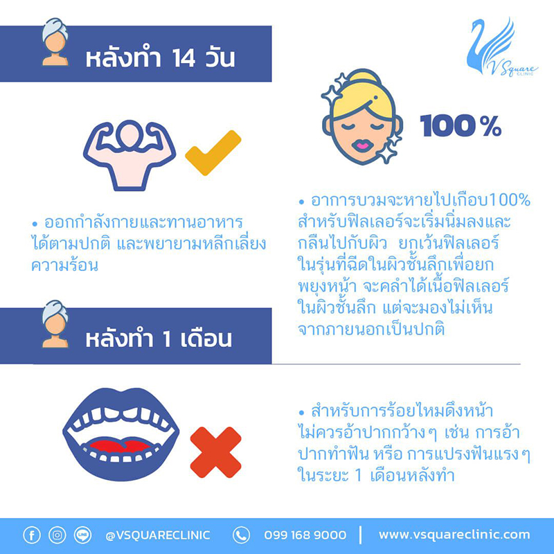 14-30-วัน-หลังฉีดฟิลเลอร์สลายเร็ว