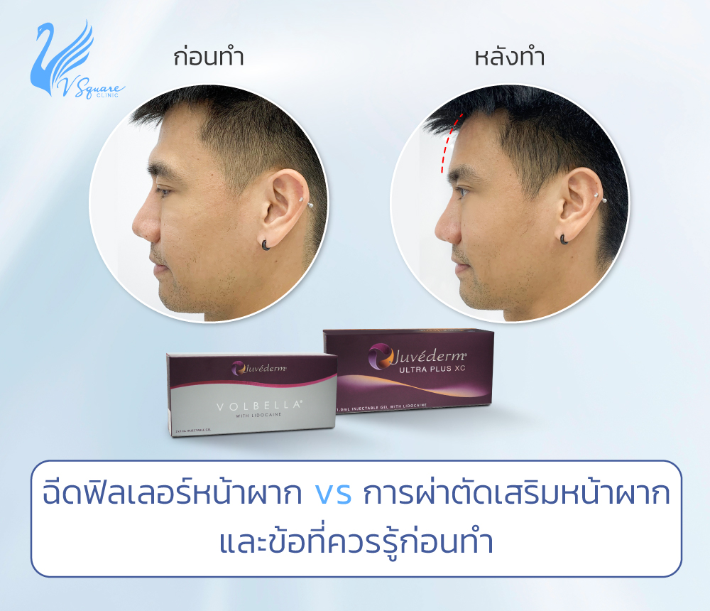 ฉีดฟิลเลอร์หน้าผาก