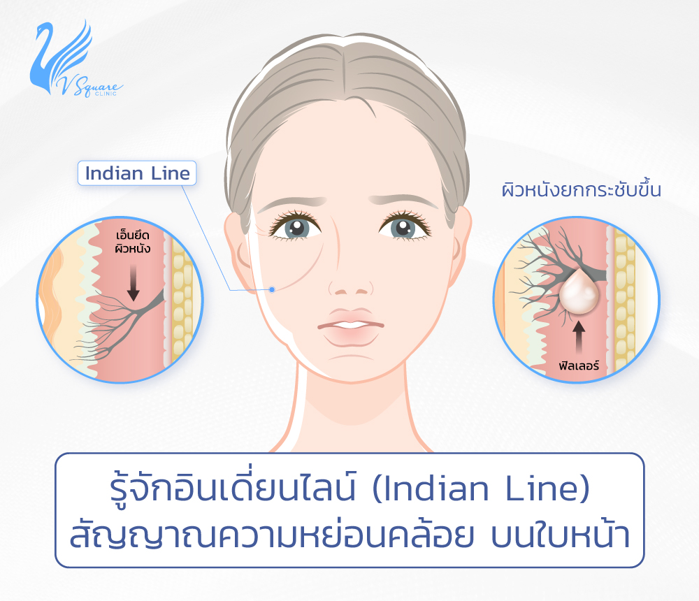 indian-line-ฟิลเลอร์ยกหน้า