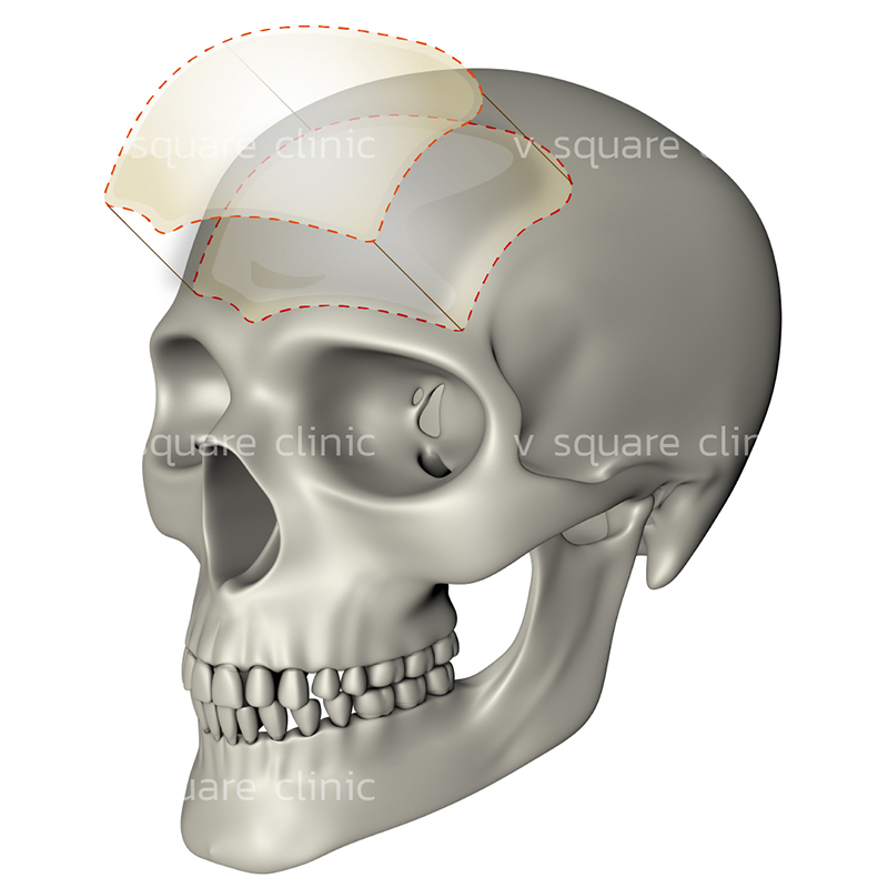 การผ่าตัดเสริมหน้าผากแบบใช้แผ่นซิลิโคน