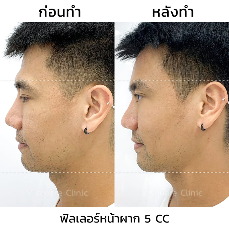 รีวิว-ฟิลเลอร์หน้าผาก-5cc-2