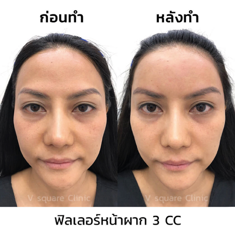 รีวิวฉีดฟิลเลอร์หน้าผาก3cc-ด้านหน้า