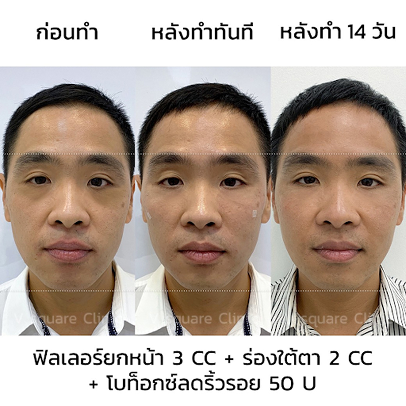 รีวิวฟิลเลอร์ยกหน้า-ผู้ชาย