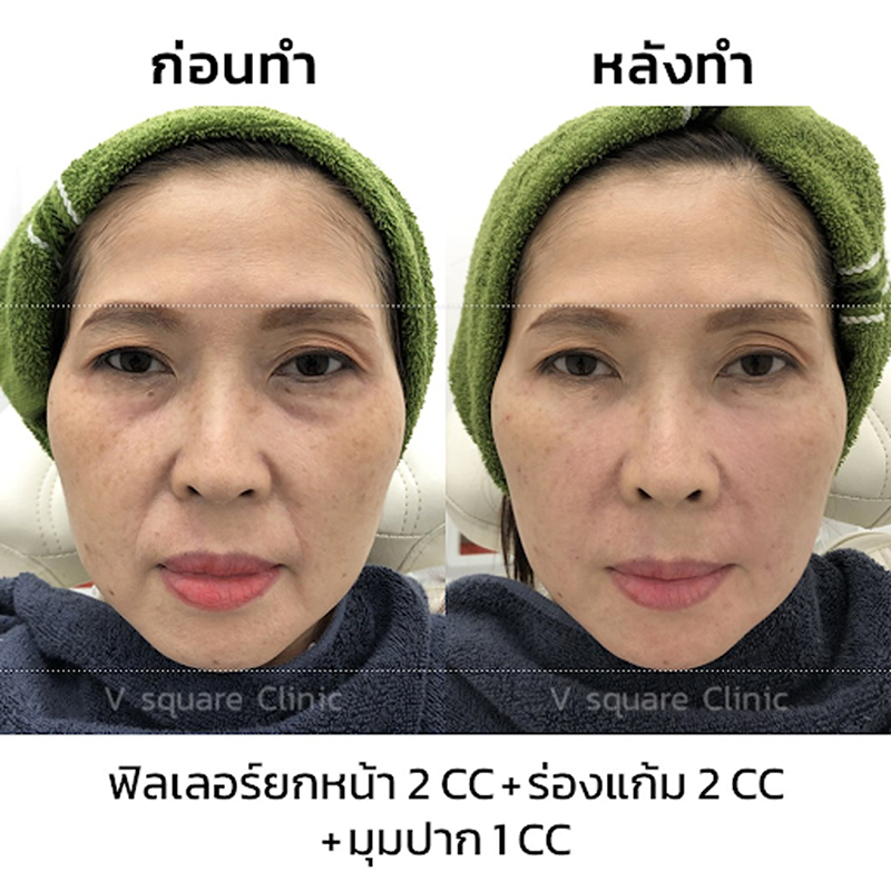 รีวิวฟิลเลอร์ยกหน้า-ผู้หญิง