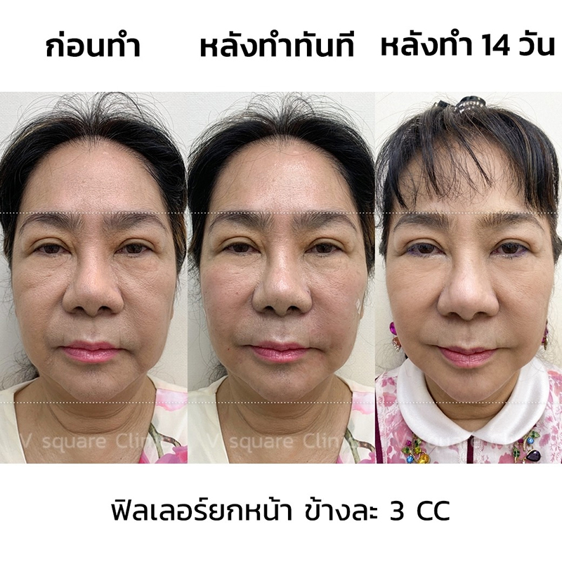 รีวิวฟิลเลอร์ยกหน้า