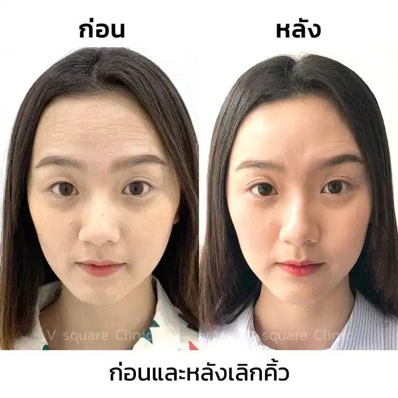 ฉีดโบลดริ้วรอยหน้าผาก