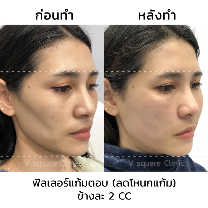 รีวิวฉีดฟิลเลอร์แก้มตอบ