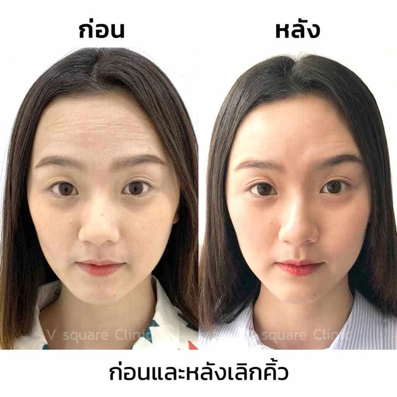 รีวิวฉีดโบท็อกริ้วรอย