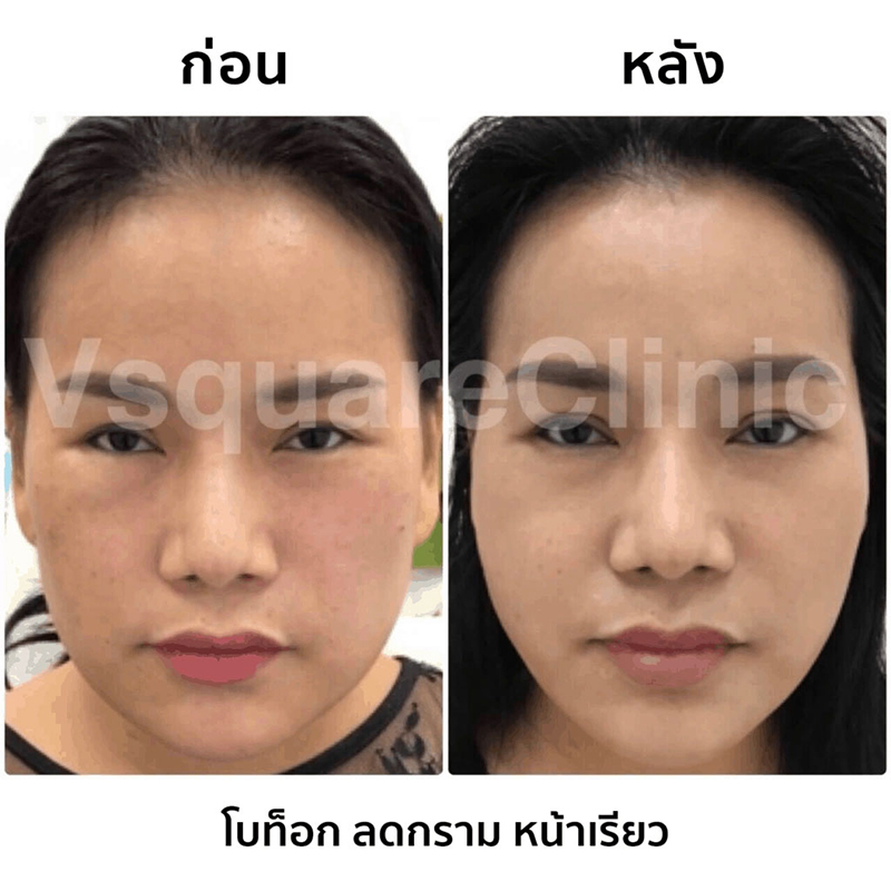 รีวิวฉีดโบท็อกลดกราม รีวิวฉีดโบท็อกลดกราม