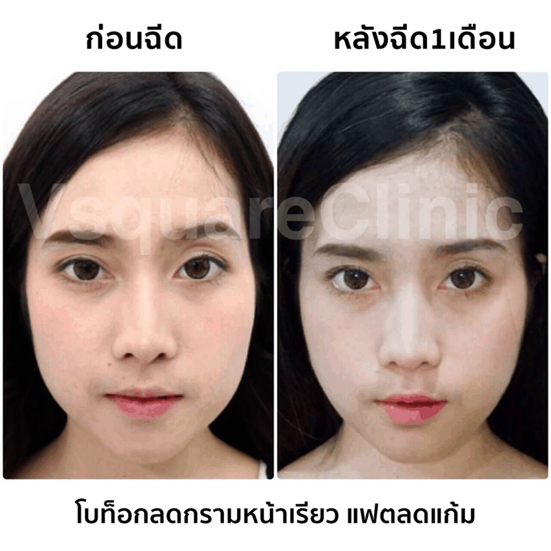 รีวิวฉีดโบท็อกลดแก้ม รีวิวฉีดโบท็อกลดแก้ม