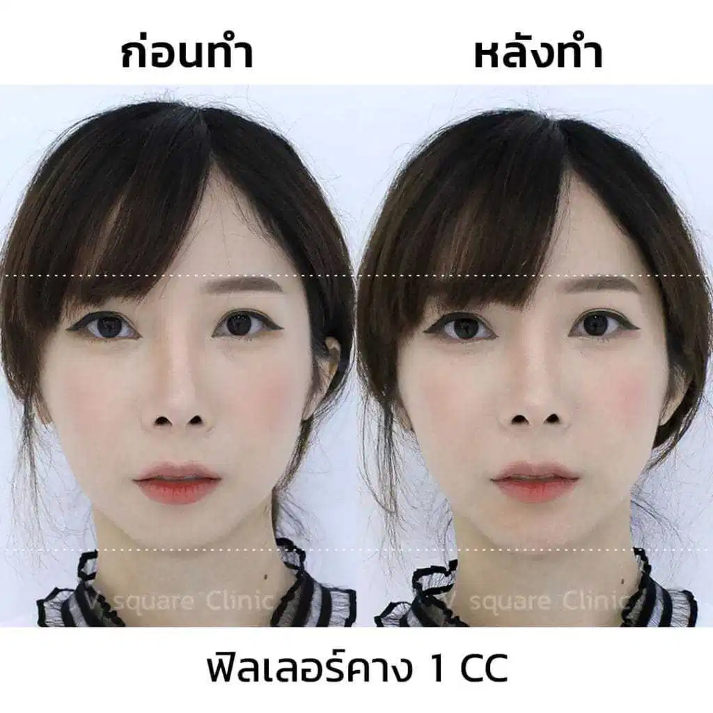 รีวิวฉีดฟิลเลอร์-Juvederm