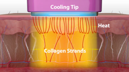 Cooling Tip Thermage FLX