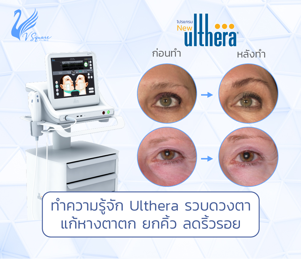Ulthera รอบดวงตา