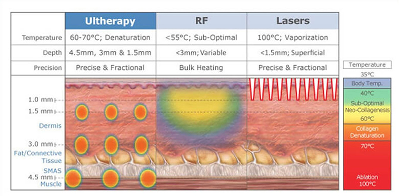 ulthera ส่งพลังงานลึกถึงชั้น SMAS