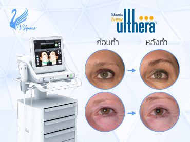 ulthera รอบดวงตา