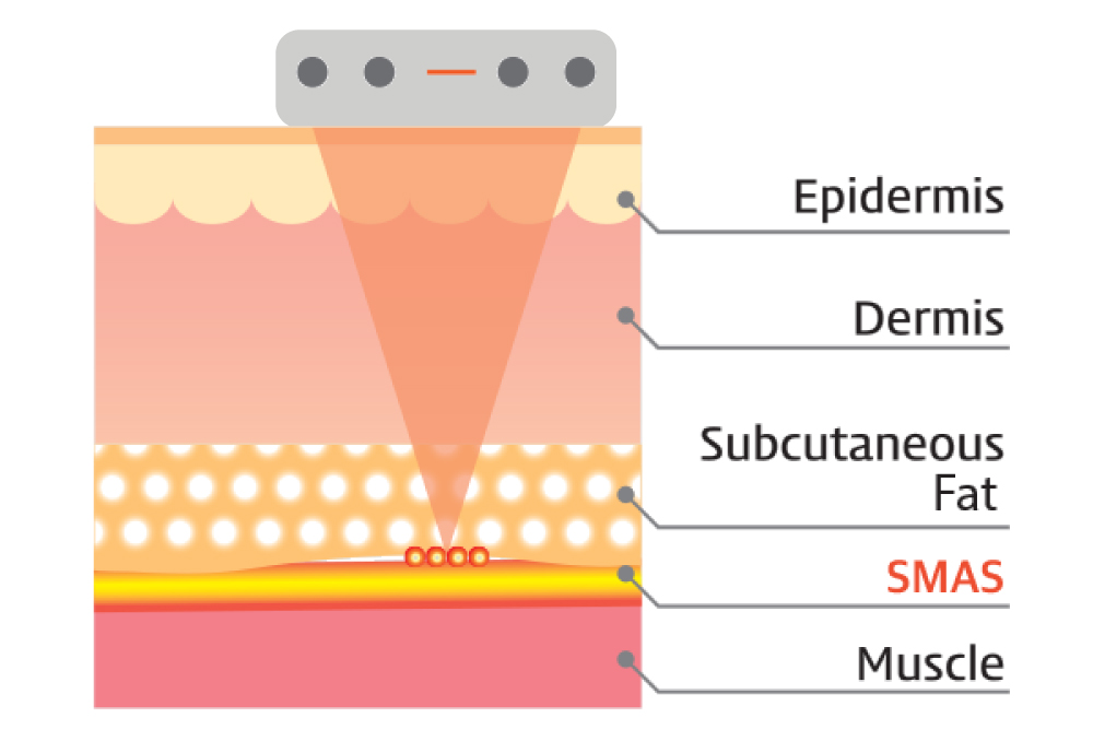 ชั้นเนื้อเยื่อ-SMAS-มีประโยชน์อย่างไร