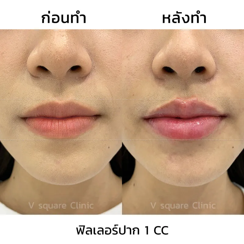 รีวิว ฟิลเลอร์ปาก 1 CC