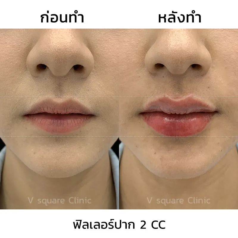 รีวิว ฟิลเลอร์ปาก 2 CC