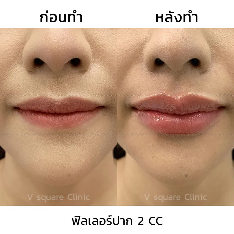 รีวิว ฟิลเลอร์ปาก 2 CC