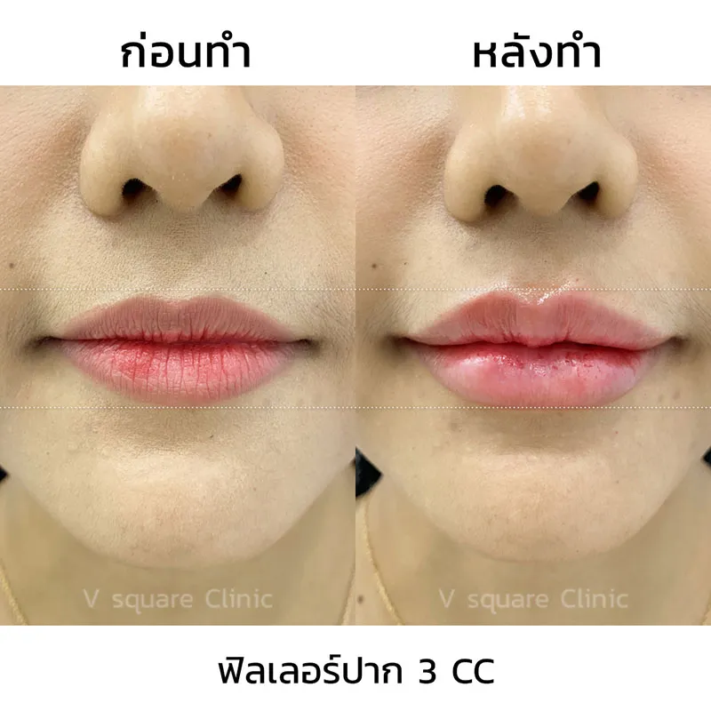 รีวิว ฟิลเลอร์ปาก 3 CC