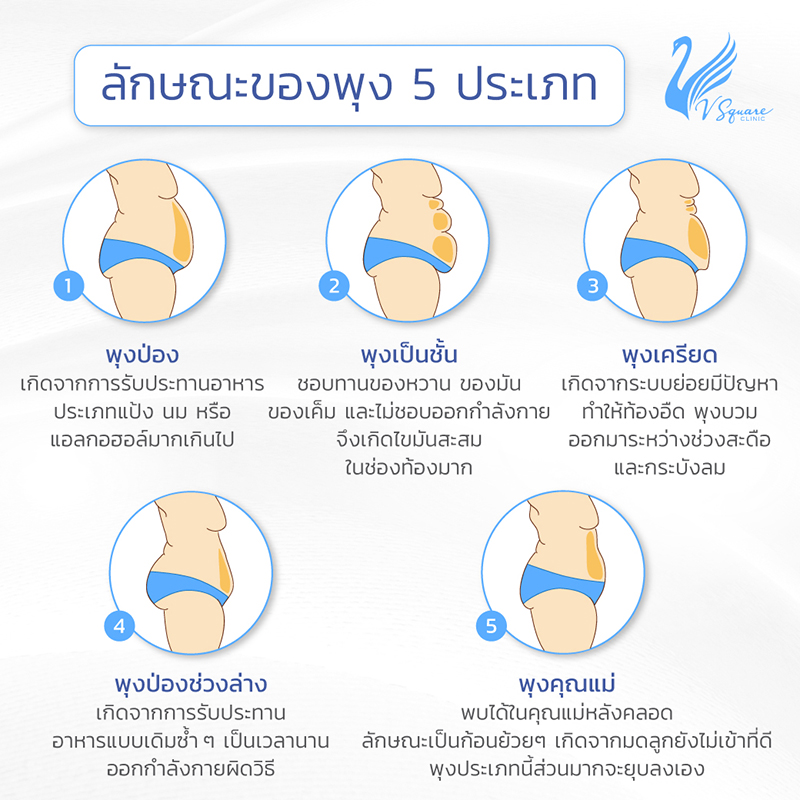 ลักษณะพุง 5 ประเภท