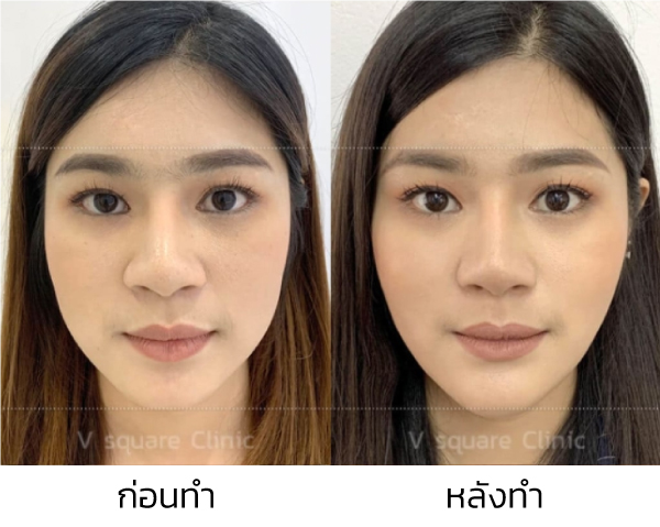 รวมวิธีปรับรูปหน้าให้เรียวสวย V-Shape เฉพาะบุคคล วิธีไหนดี เหมาะสมปลอดภัย รวมวิธีปรับรูปหน้าให้เรียวสวย V-Shape เฉพาะบุคคล วิธีไหนดี เหมาะสมปลอดภัย