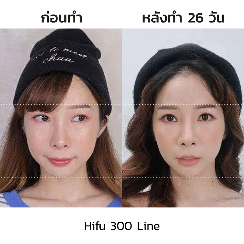 hifuปรับรูปหน้า