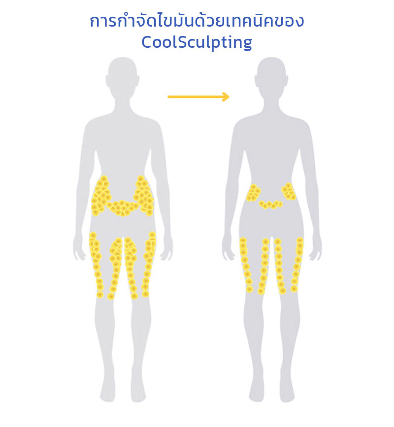 การลดไขมันของ Coolsculpting