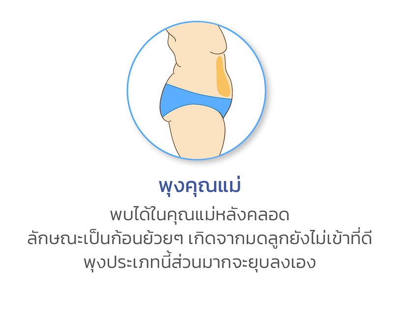 พุงคุณแม่