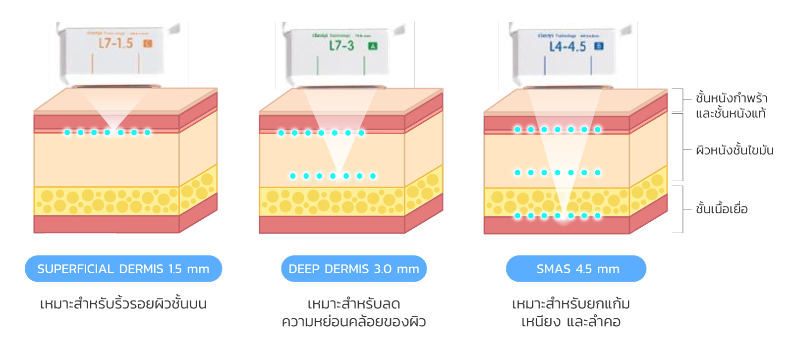 ระดับความลึกในการยิงของ หัว Ulthera