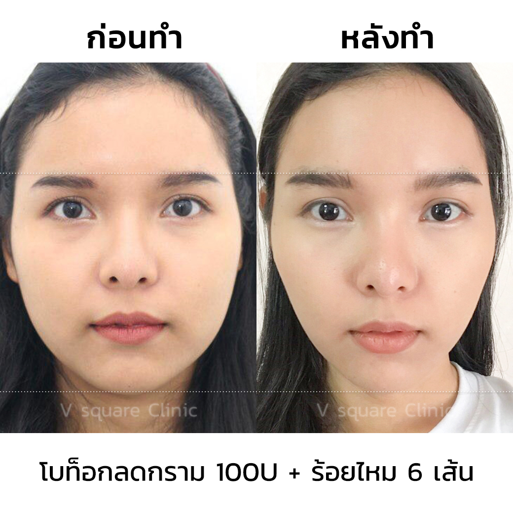 รีวิวทำหน้าวีเชฟ ด้วยฟิลเลอร์