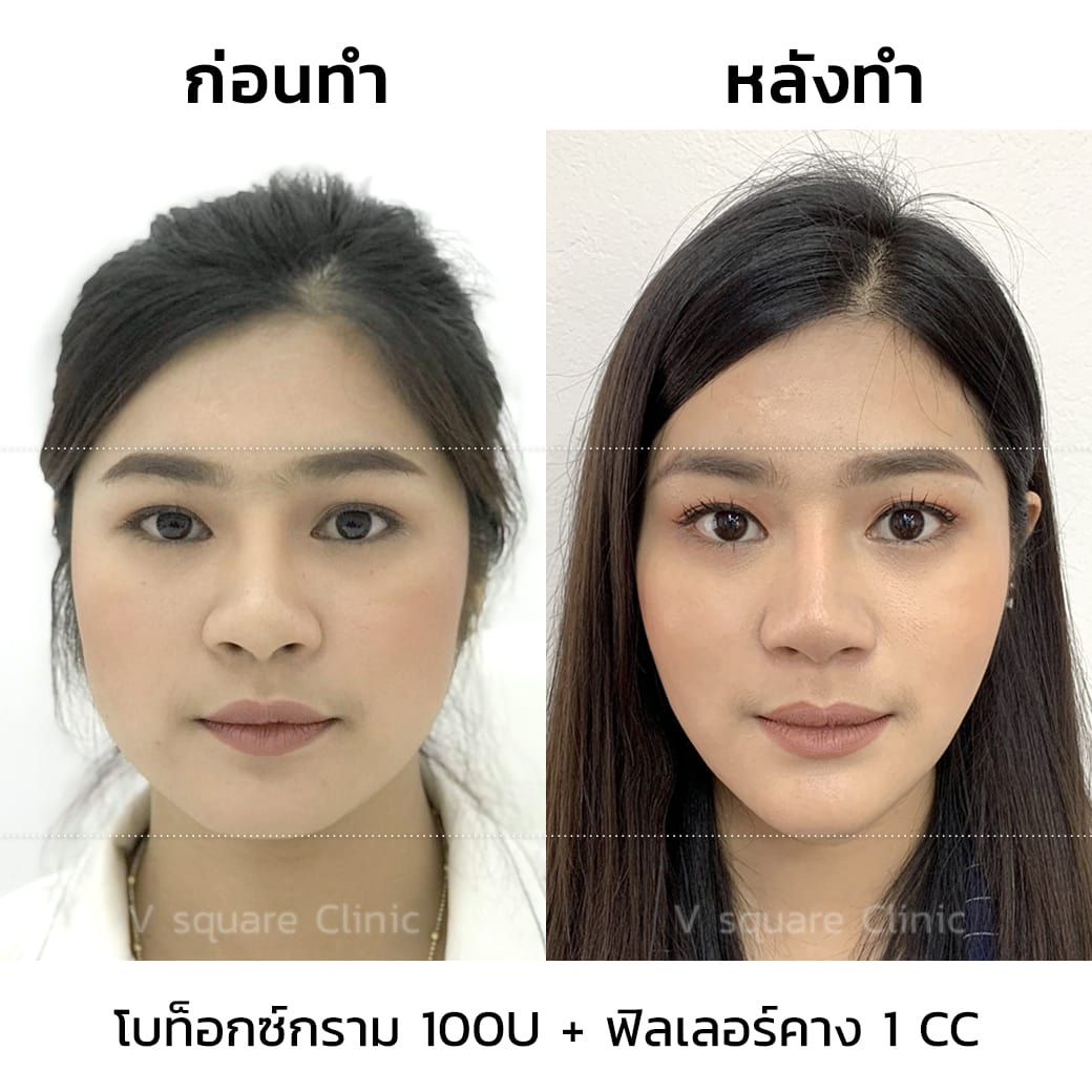 รีวิวทำหน้าวีเชฟ ด้วยโบท็อกและฟิลเลอร์