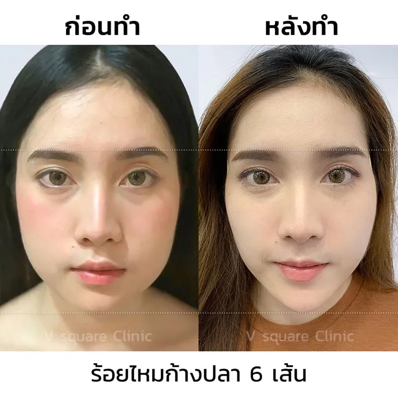 ร้อยไหมหน้าเรียว ที่ไหนดี