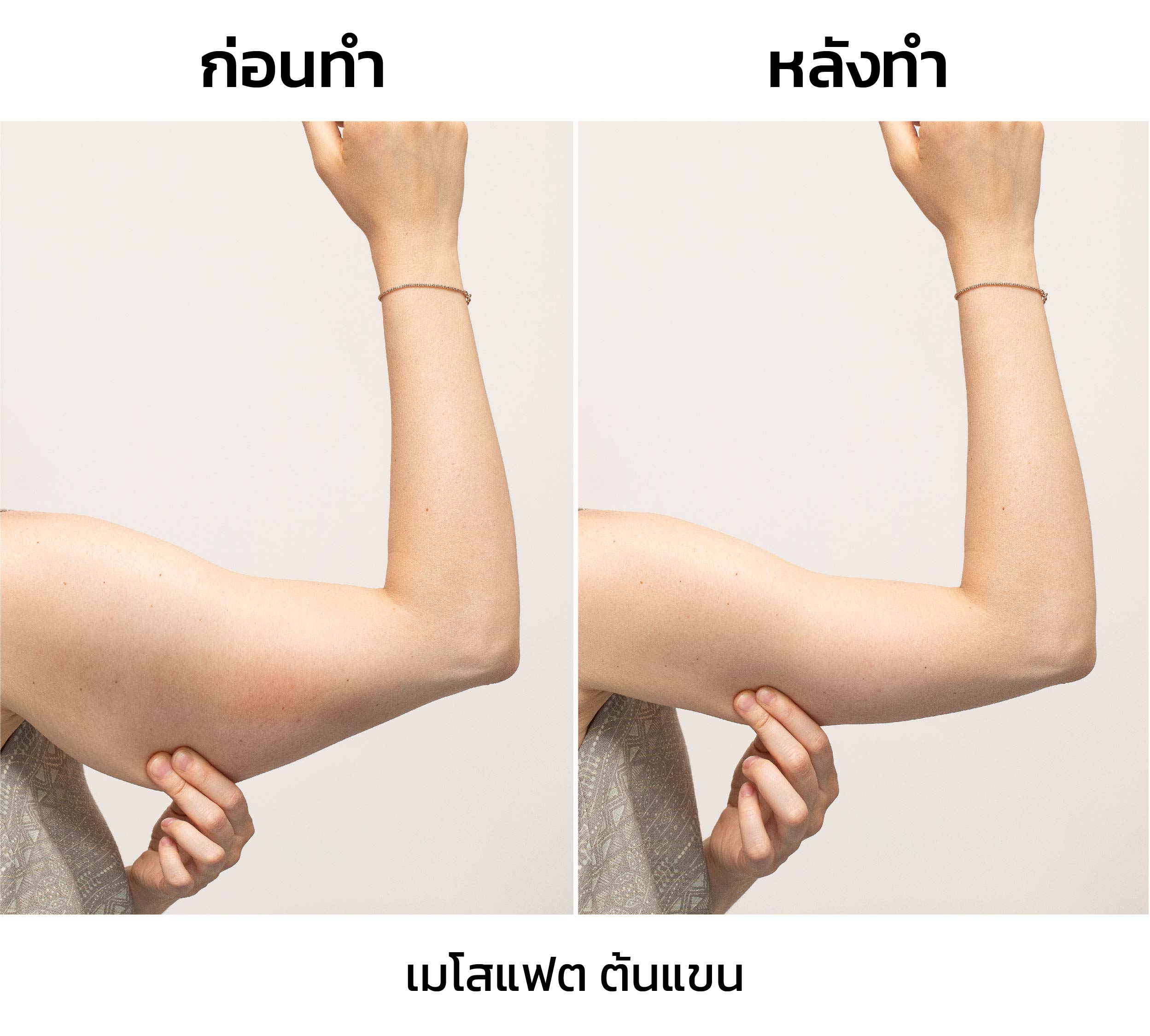 เมโสแฟตต้นแขน รีวิว_01