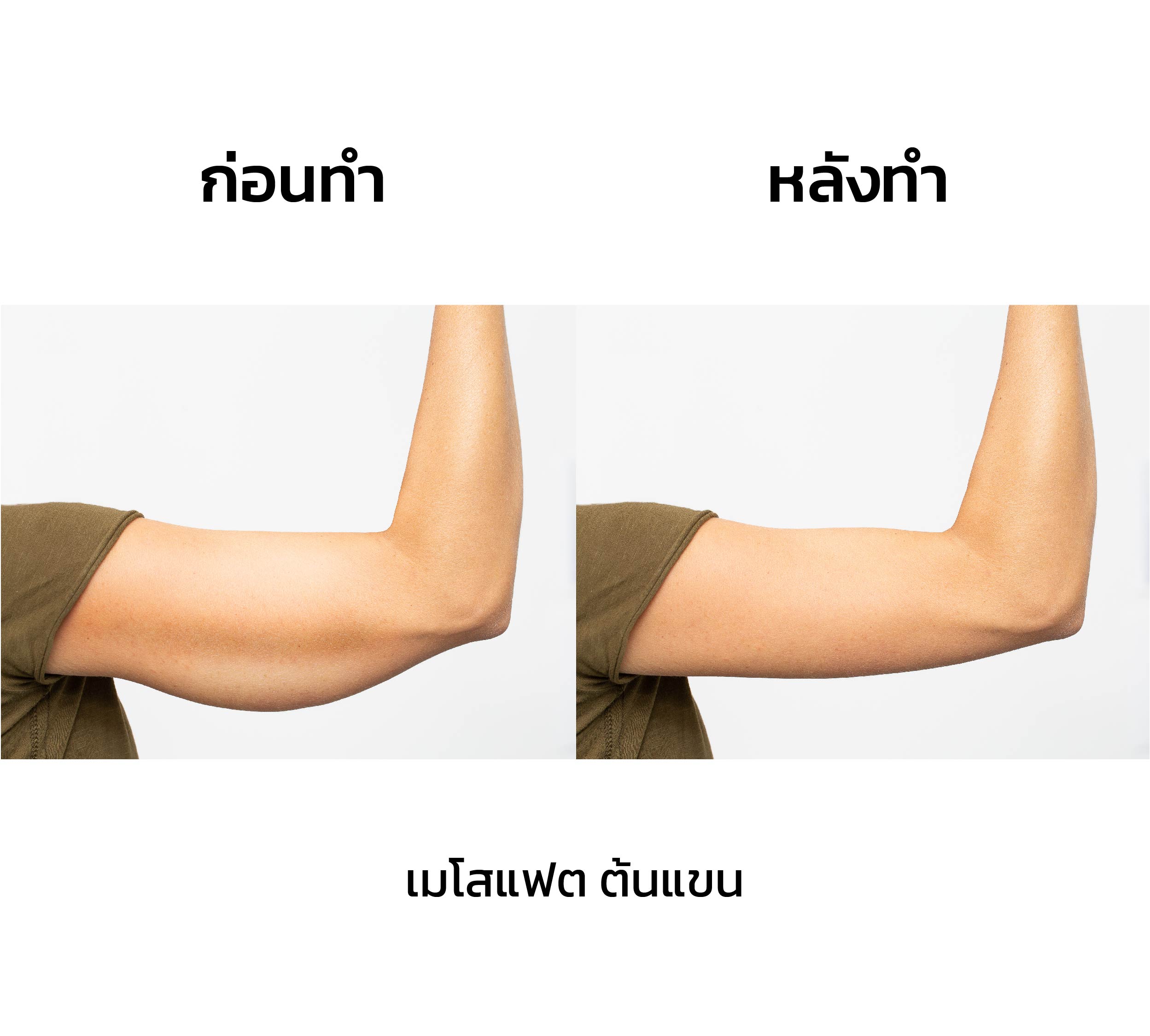 เมโสแฟตต้นแขน รีวิว_03