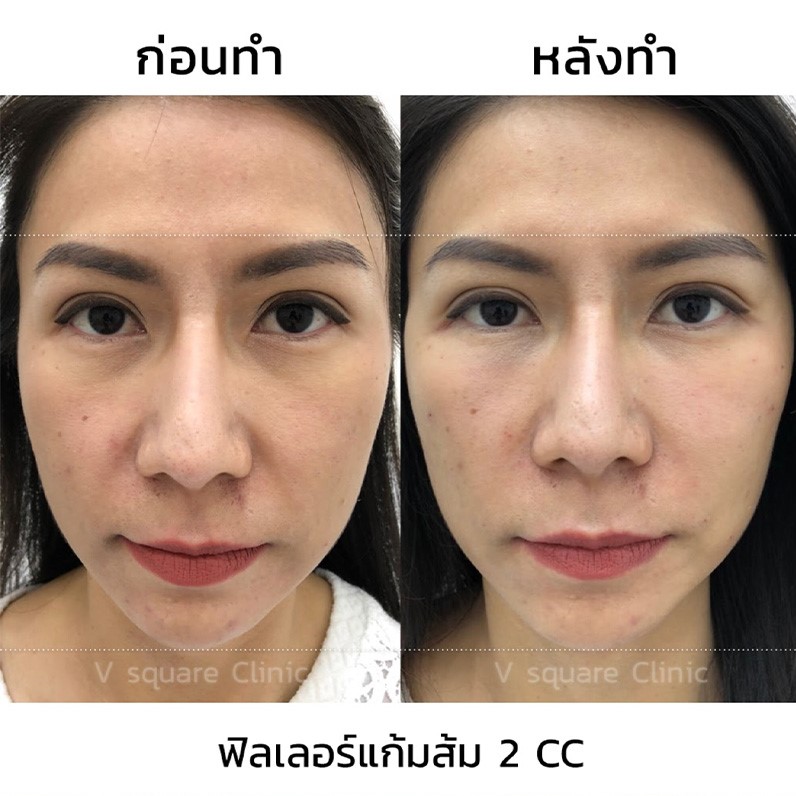 แก้มไม่เท่ากัน ใหญ่ข้างเล็กข้าง และวิธีแก้ไข ปรับรูปหน้าให้เท่ากัน แก้มไม่เท่ากัน ใหญ่ข้างเล็กข้าง และวิธีแก้ไข ปรับรูปหน้าให้เท่ากัน