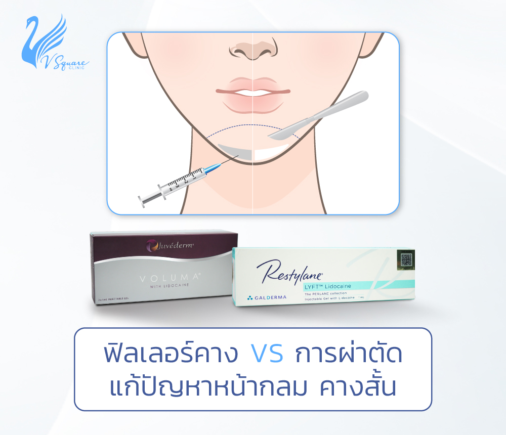 เสริมคางแบบไหนดี ? ฉีดฟิลเลอร์คาง VS ผ่าตัด วิธีไหนเหมาะกับใคร ? เสริมคางแบบไหนดี ? ฉีดฟิลเลอร์คาง Vs ผ่าตัด วิธีไหนเหมาะกับใคร ?