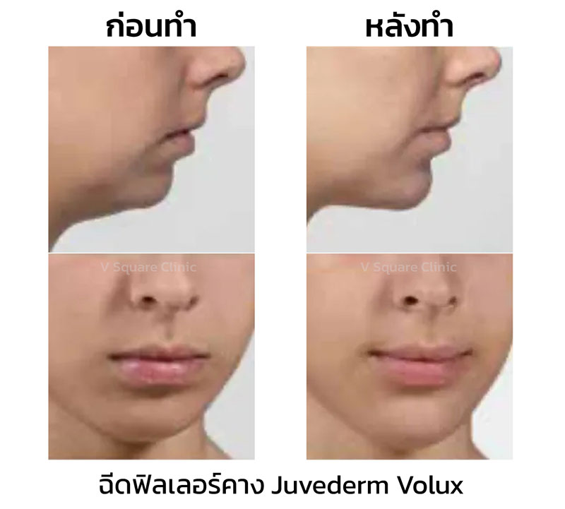 ฉีดฟิลเลอร์ Juvederm Volux ปรับรูปคาง