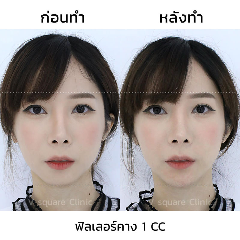 รีวิว ฉีดฟิลเลอร์คาง 1 CC