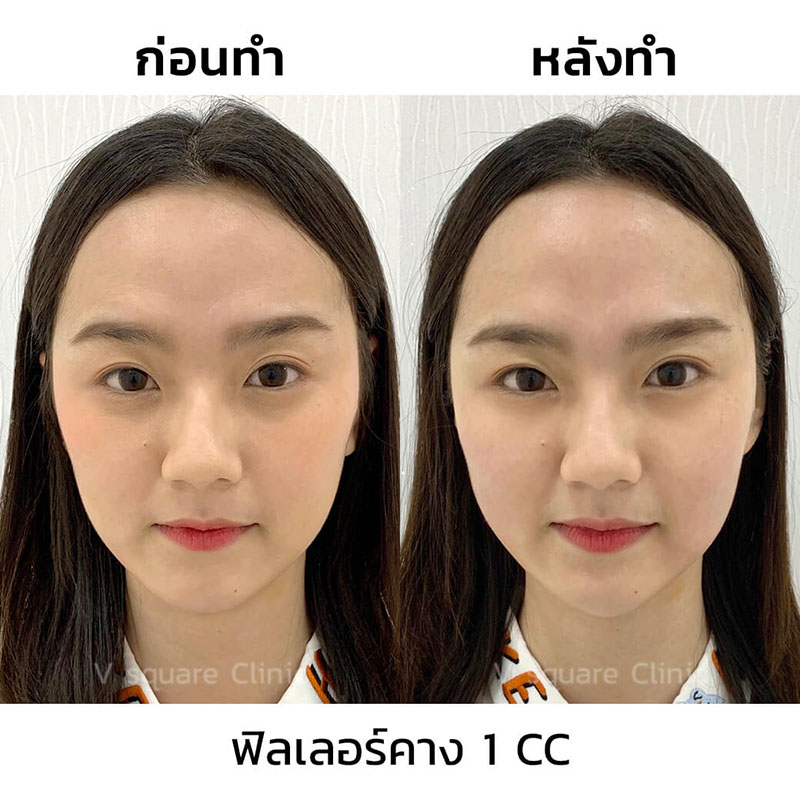 รีวิว ฉีดเสริมคาง 1 CC