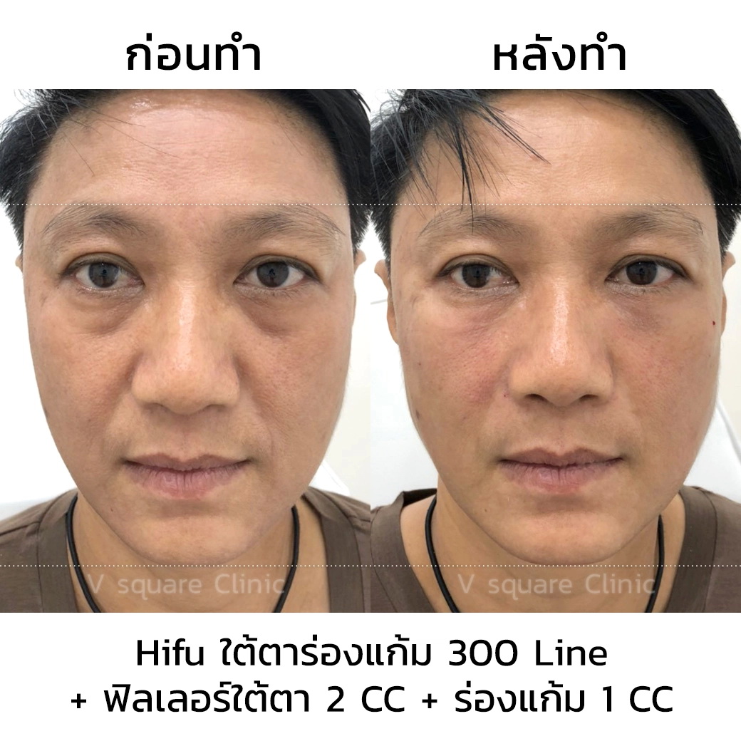 ลดริ้วรอยใต้ตาด้วย Hifu Ultrafomer III