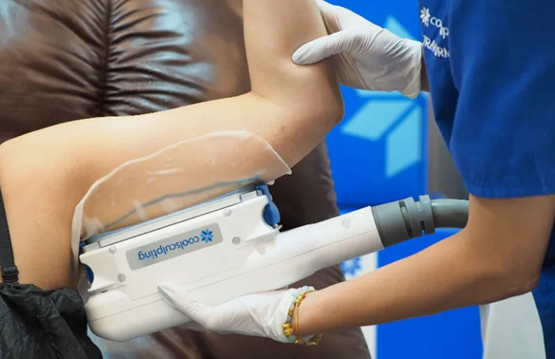 CoolSculpting กำจัดไขมันต้นแขน