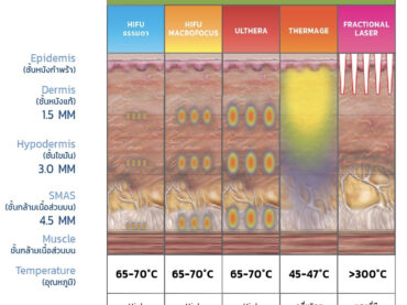 Ulthera vs Hifu ยี่ห้อต่าง ๆ