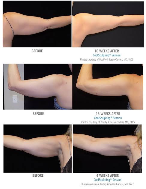 ตัวอย่างรีวิวผลการรักษาด้วยเครื่อง CoolSculpting (3)