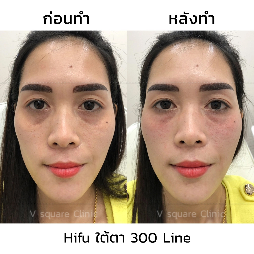 รีวิว Hifu 300 line