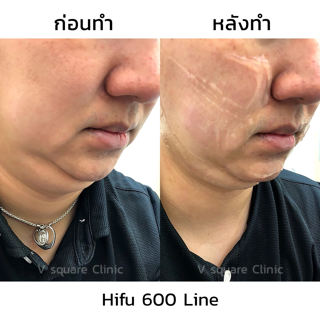 รีวิว Hifu 600 line