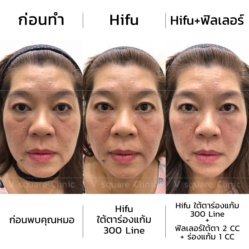 รีวิว Hifu ใต้ตา ร่องแก้ม 300 line.1