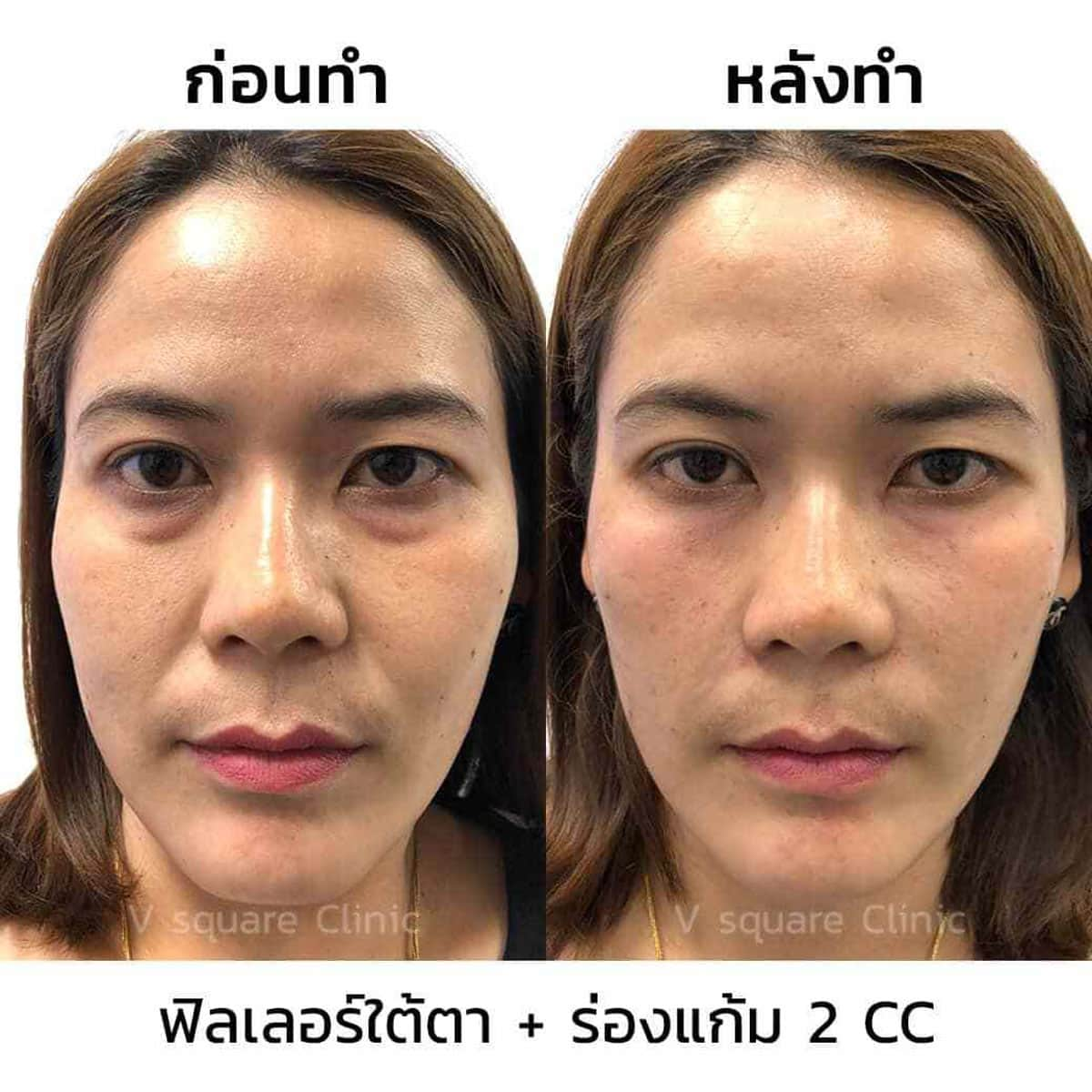 รีวิวฉีดฟิลเลอร์ใต้ตา1